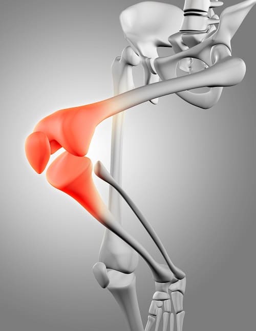Artroplastia de rodilla